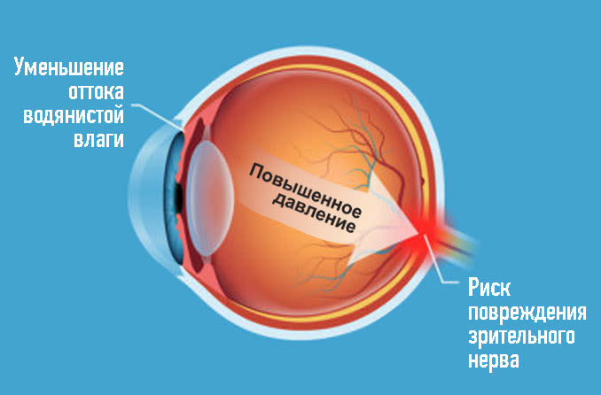RU-ocular-hypertension-678x446.jpg