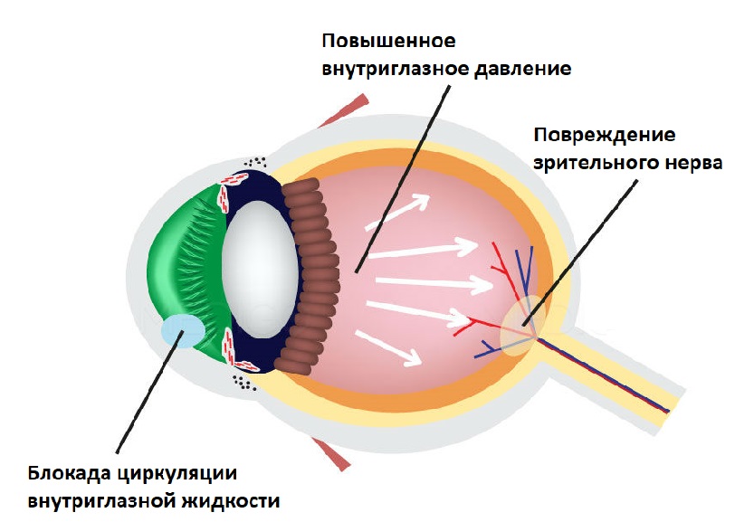Operaciya pri glaukome 2.jpg