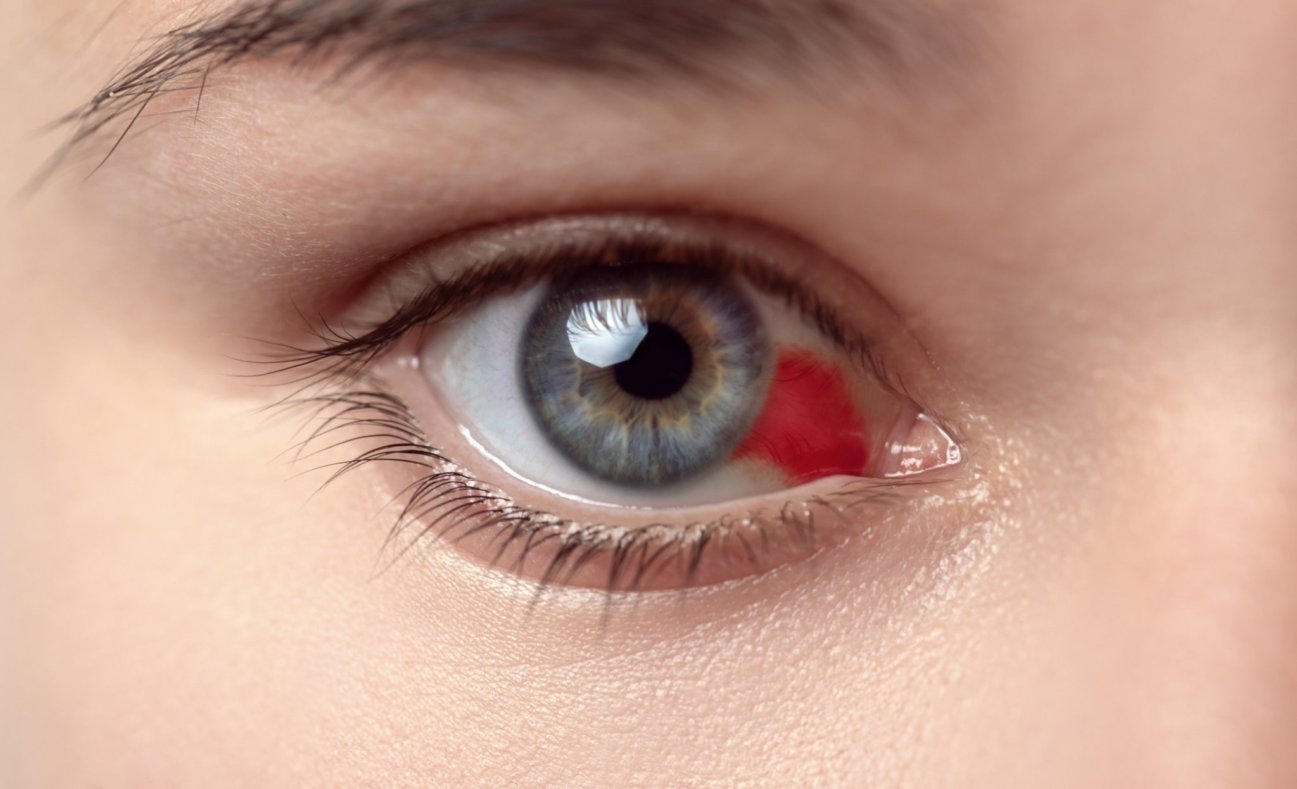 Красные пятна в глазах - почему краснеют и болят глаза?