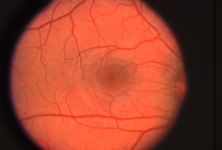 Кровоизлияния в сетчатке ретинопатия