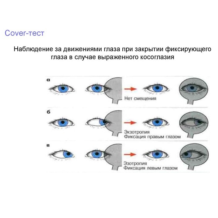 Исправление косоглазия у взрослых операция. Косоглазие строение глаза. Нарушение бинокулярного зрения косоглазие. – Декомпенсированное.косоглазие. Косоглазие причины симптомы.