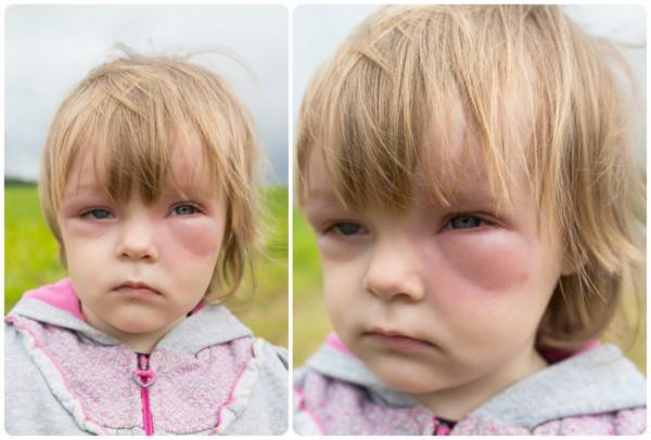 Ангионевротический отек век — аллергический отек Квинке у ребенка. Как  снять аллергический отек глаз