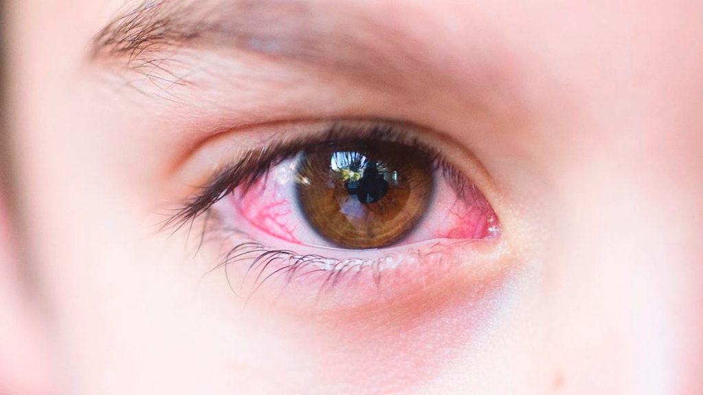 Кератит — симптомы и лечение при кератите глаза. Что за болезнь кератит и  чем его лечат. Капли и инъекции при кератите