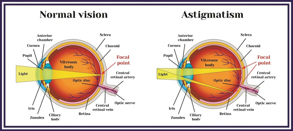 zrenie_pri_astigmatizme1-min-1.jpg