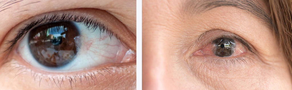 Pterygium-l.jpg Pterygium-l.jpg